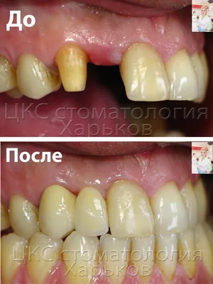 Мостовидное протезирование зубов в Запорожье | Dental Studio