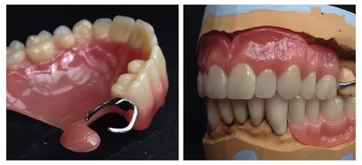 Ремонт бюгельного зубного протеза на крючках - Видео - Блог |  Стоматологическая клиника Не Болит!