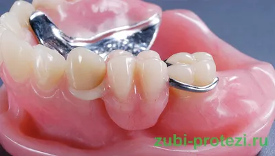Как закрепить съемные зубные протезы: крючки, присоски, имплантаты, замки