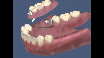 Как привыкнуть к зубным протезам - Стоматология Медикор