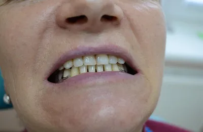 Съемные зубные протезы в Хабаровске: цены, виды и отзывы в EsteticaDent.ru