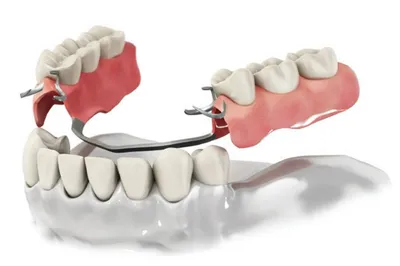Съемные зубные протезы по низким ценам - Краснодар. Стоимость на частичное  и полное съемное протезирование