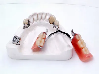 Съемные зубные протезы на имплантатах. Клиника профессора Абакарова
