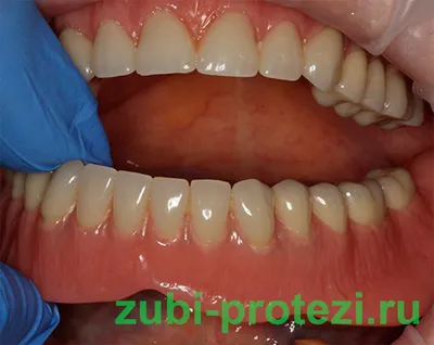 Зубные протезы на крючках - плюсы и минусы кламмеров