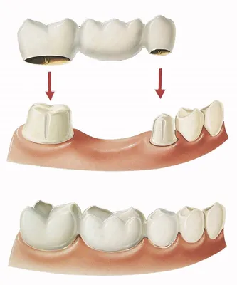 Протезирование 32 Зубов Что Это Такое Люмидент