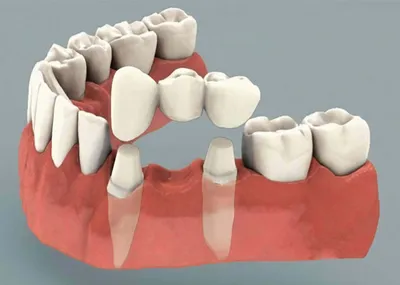 Зубные протезы в Нижнем Новгороде и Щербинках – протезирование в  стоматологии Смайлик