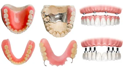 Какие протезы для зубов лучше - виды: как выбрать протезы для зубов  правильно