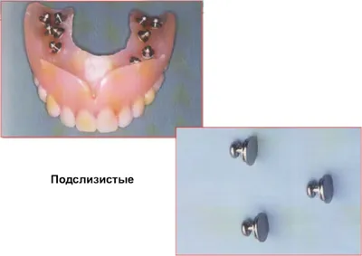 Съемные зубные протезы — виды и цены в Москве на съемное протезирование