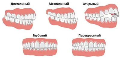 Прикус зубов человека — виды и аномалии | Н-Лайт