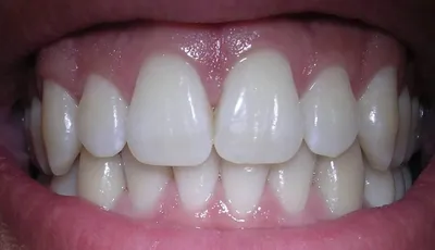 Зубы человека фото фотографии