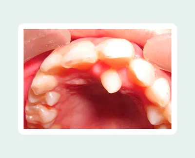 Сверхкомплектные зубы - что это, гипердонтия, причины, лечение  сверхкомплектных зубов