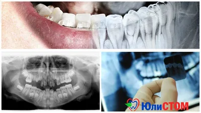 Что делать, если откололся кусочек зуба? Стоматология Ликс Дент