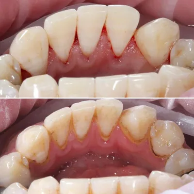 Зубы Человека До И После Стоматологического Лечения — стоковые фотографии и  другие картинки Впереди - iStock