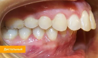 Какие зубы у человека портятся самыми первыми и почему? | STOMOS - Центр  Стоматологии Доктора Осипова | Дзен