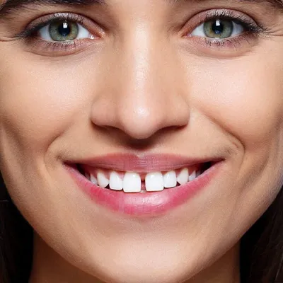 Зубы человека перед и после забеливать Стоковое Фото - изображение  насчитывающей осмотр, сравните: 148977442
