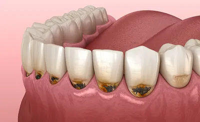 Пришеечный кариес зубов – причины, симптомы, лечение в Москве – цены,  отзывы в стоматологических клиниках Зуб.ру