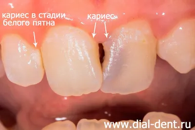 Кариес передних зубов – лечение перед установкой брекетов