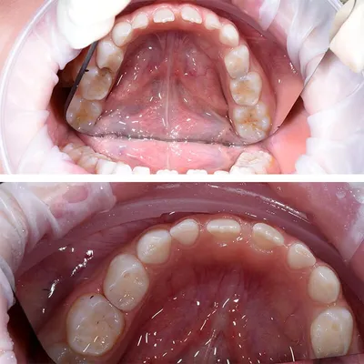 Лечение кариеса молочных зубов | Работы врача-стоматолога Грыцив Э. И. |  Наши работы