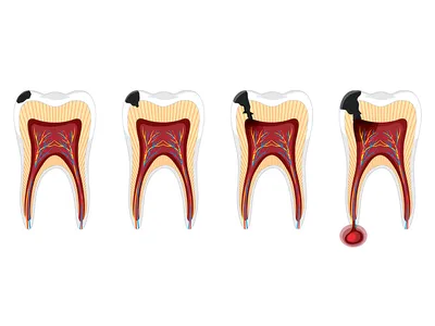 COViD-19 и кариес зубов