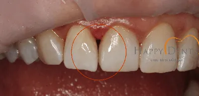 Лечение кариеса в стоматологии Подольск | Стоматология Улыбка