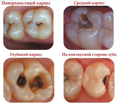 Лечение глубокого кариеса на 27 зубе, фото до и после, пример работы 29414