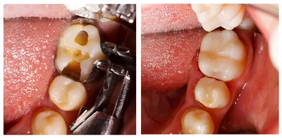 Качественное лечение кариеса зубов: цены, отзывы, фото До и после