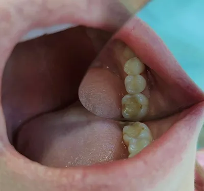 Кариес \"дырка\" в зубе. Как обнаружить и зачем нужен рентгеновский снимок?  Некариозные поражения. | Правдивая стоматология доктора Аболмасова | Дзен