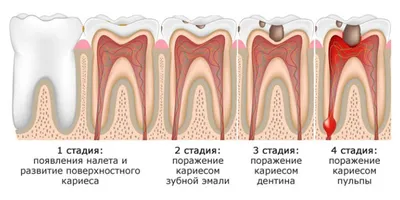 Лечение скрытого кариеса между зубами - Nano Clinic