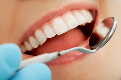 Кариес передних зубов | Стоматология в Красноярске \"ВОКА\" -  стоматологическая клиника