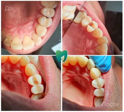 Апроксимальный кариес — сложности в выявлении и профилактике — Эстетическая  стоматология Deva-Dent в Москве