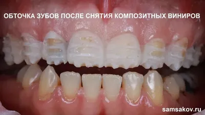 Как заменить старые виниры на новые зубы? | Альянс бьюти-ортопедов, Москва