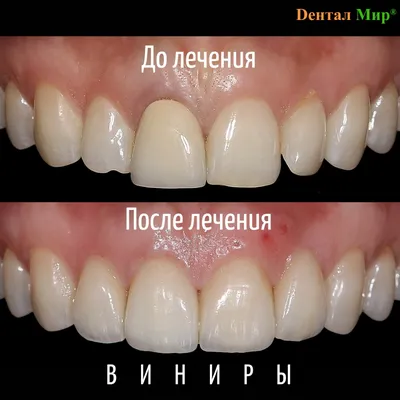 Как заменить старые виниры на новые зубы? | Альянс бьюти-ортопедов, Москва