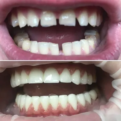 Как ставят виниры на зубы: этапы и уход, цена на установку зубных накладок  в стоматологии