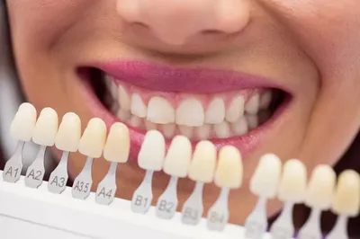 МОЖНО ЛИ ХОДИТЬ СО СВОИМИ ЗУБАМИ ПОСЛЕ СНЯТИЯ ВИНИРОВ ❓ ⠀ Виниры – это  белоснежные, ровные, блестящие и привлекательные зубы! Редко, когда… |  Instagram