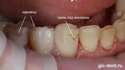 Когда виниры недорого стоят это плохо для зубов – Немецкий  имплантологический центр, Москва