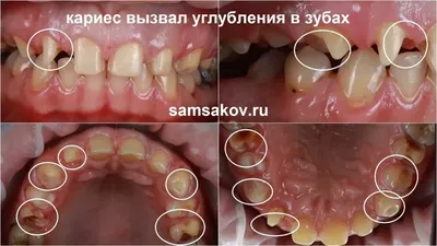 Врачи-стоматологи объяснили, что такое керамические виниры и как за ними  ухаживать