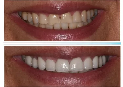 Виниры на зубы в Yes-стоматологии | yes-dantist.ru
