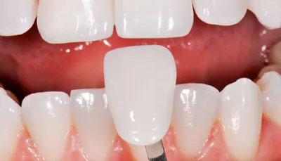 Патологическая стираемость. Как восстановить зубы при помощи керамических  виниров