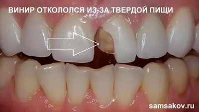 Как заменить старые виниры на новые зубы? | Альянс бьюти-ортопедов, Москва