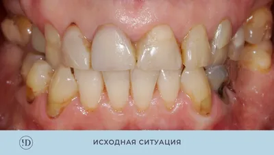 Керамические виниры виды и цены в Москве — стоматология Лимон