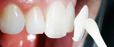 Виды виниров на зубы в стоматологии, методы изготовления
