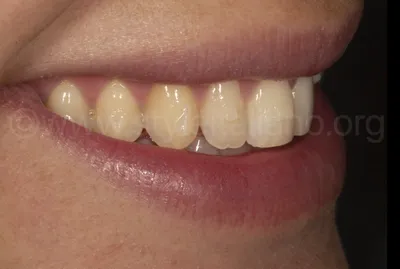 Dentist - ИСТОРИЯ ОДНОЙ УЛЫБКИ💕 ⠀ Пациентку не устраивала форма, размер и  промежутки между зубами. Ранее были установлены композитные виниры. На фото  «до» зубы, после снятия композита. На фото «после» проведена установка