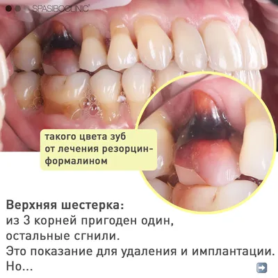 Имплантация 6 зуба в Москве под ключ недорого, цены в ДантистоФФ