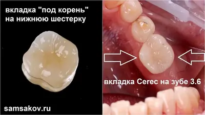 Имплантация собственных зубов. Пересадка зубов мудрости в ТОП1 клинике  Москвы – Немецкий имплантологический центр