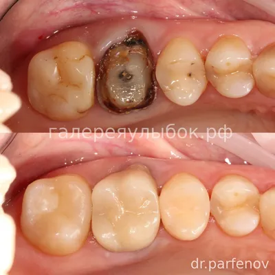 Новая неделя - новые зубы у моих пациентов 😁 Короновали две нижние шестерки  спустя 3 (примерно) месяца после имплантации двумя… | Instagram