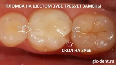 Имплантация 6 зуба в Москве под ключ недорого, цены в ДантистоФФ