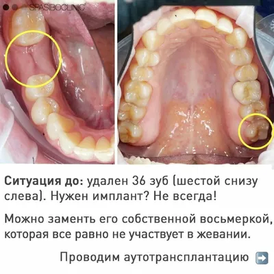 Новый случай пересадки зуба: верхняя восьмерка на место нижней шестерки  (18→36). | Спасибо.Клиник | Дзен