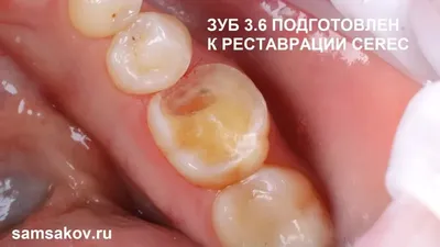 Верхние 8 зубы мудрости пересадили на место шестых нижних зубов – Немецкий  имплантологический центр, Москва