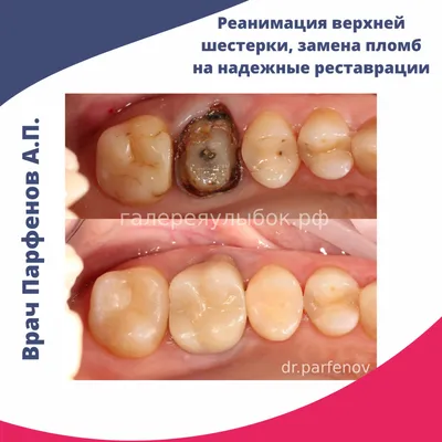 Реставрация поверхности жевательного зуба вкладкой CEREC