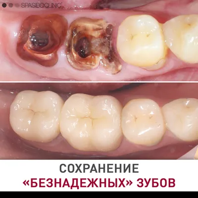 Лечение кариеса и современная реставрация зубов в СПб - Стоматологическая  клиника \"Галерея Улыбок\"